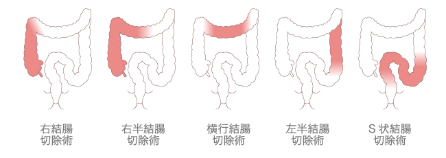 大腸がんの治療(手術)