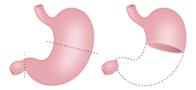 (図4)幽門側胃切除術