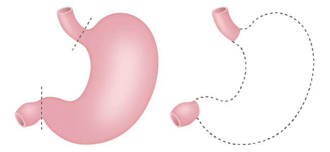 (図5)胃全摘術