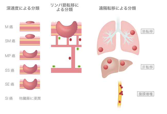 大腸がんの進行度 分類