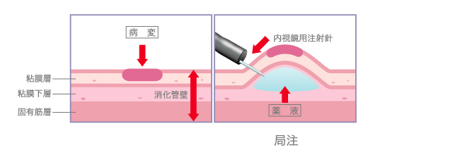 内視鏡的粘膜下層剥離術(ESO)1