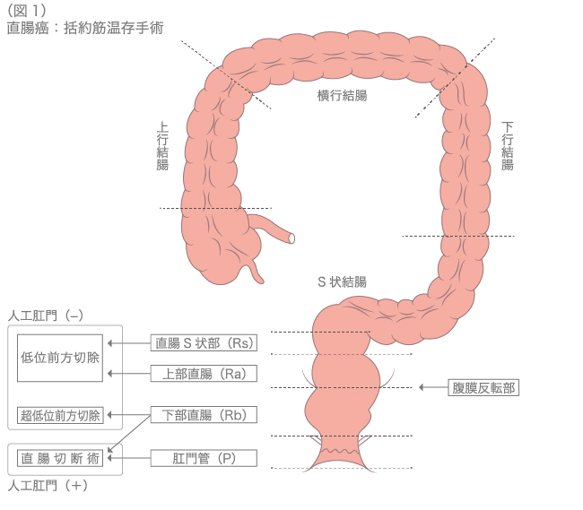 直腸癌：括約筋温存手術　図1
