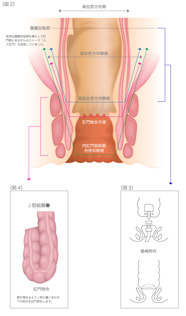 直腸癌：括約筋温存手術　図2