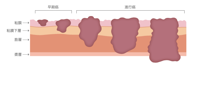 (図2)胃壁の構造と胃がんの進行度