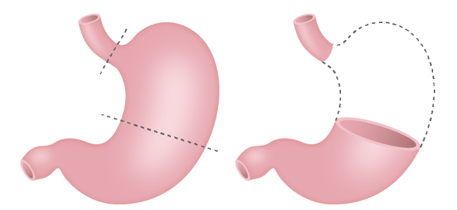 (図3)噴門側胃切除術
