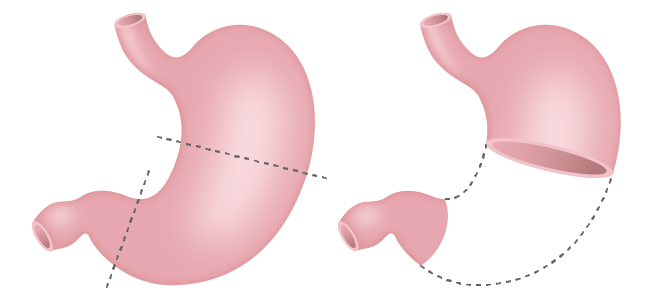 (図6)幽門保存胃切除術